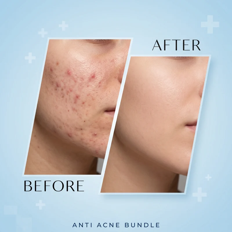 ANTI ACNE BUNDLE - Image 2
